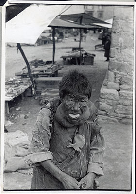 Tibetan woman with goitre